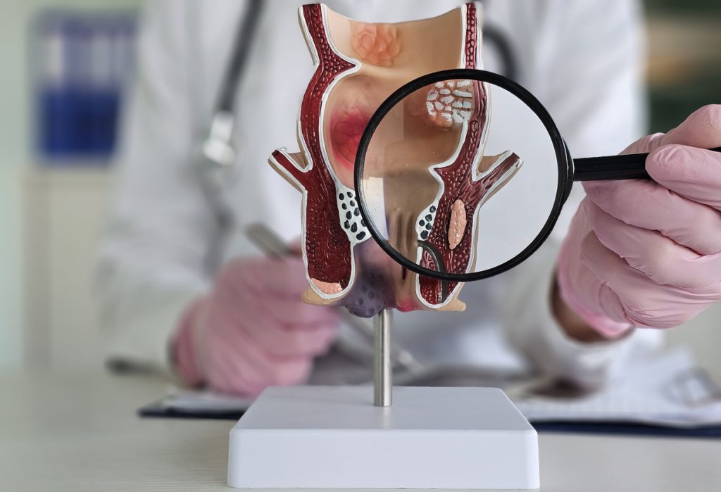 Are Hemorrhoids Causing Your Bleeding?